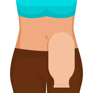 colostomy