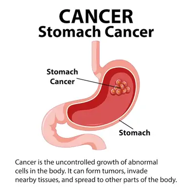 Stomach-cancer-image