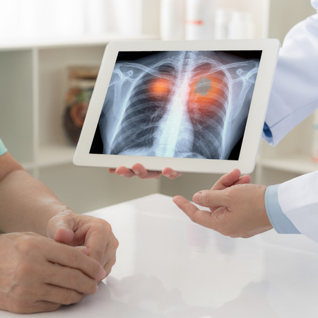 lung-cancer