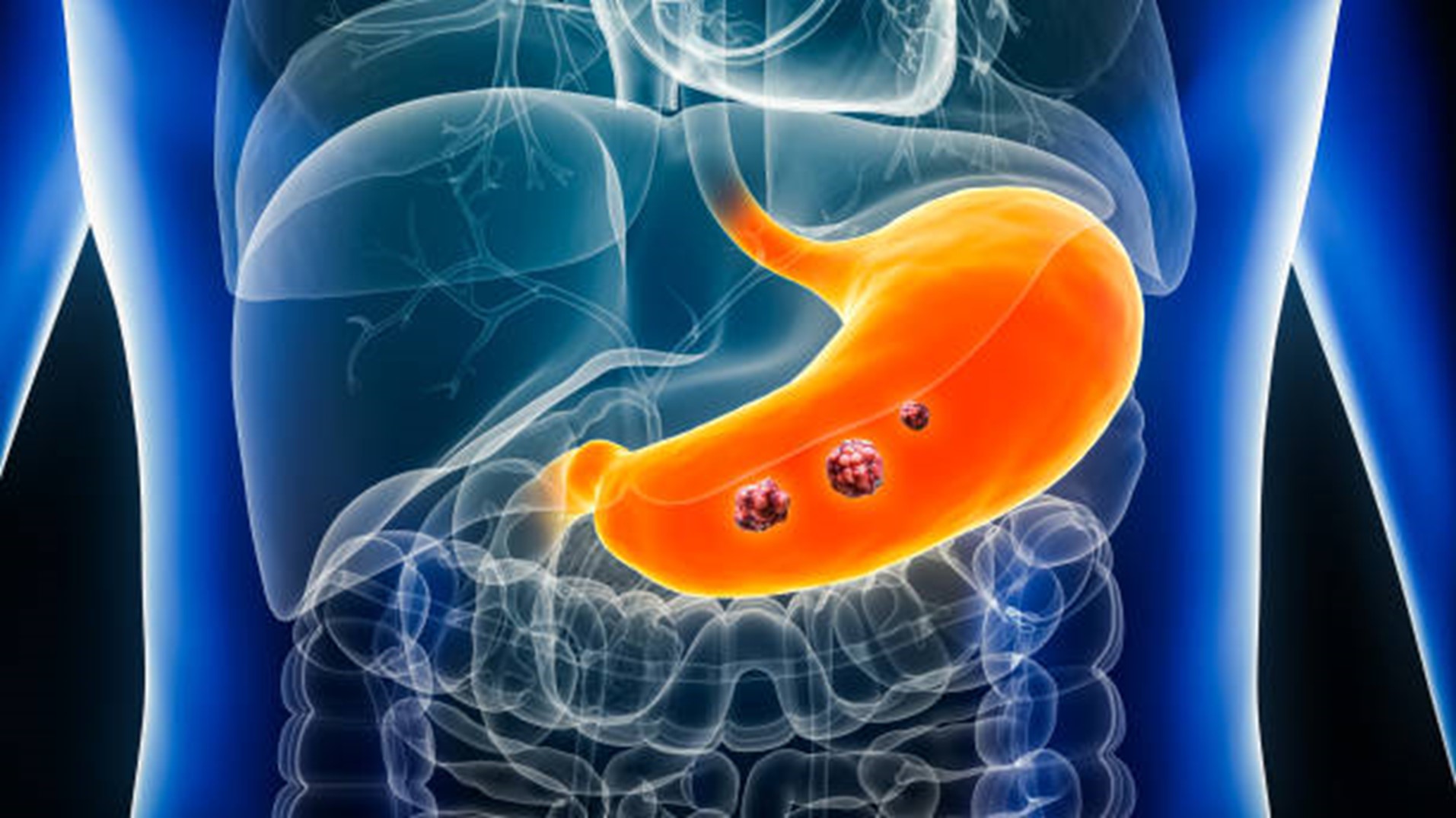 Battling Stomach Cancer At 30