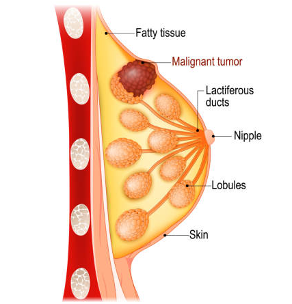 Breast Cancer