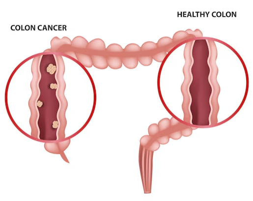 Colon Cancer