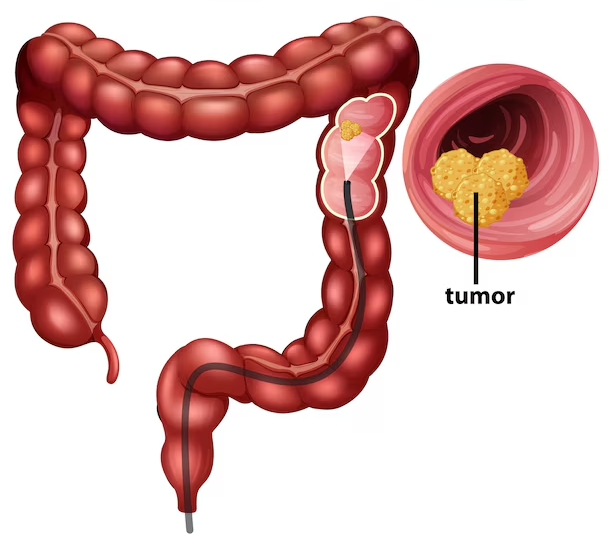 Colorectal Cancer