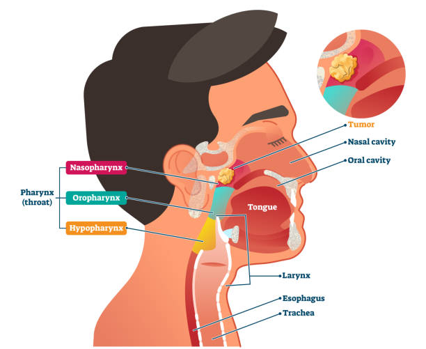 Head and Neck Cancer