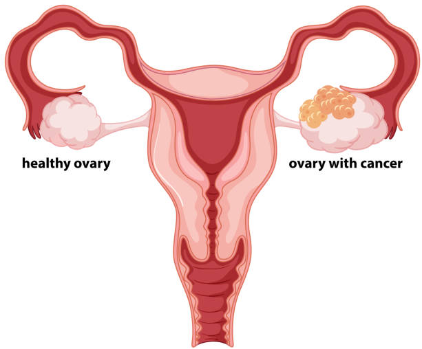 Ovarian Cancer