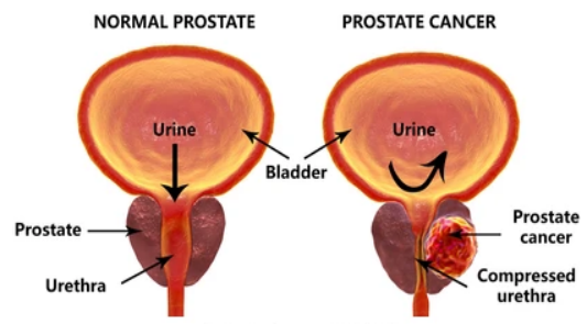 Prostate Cancer