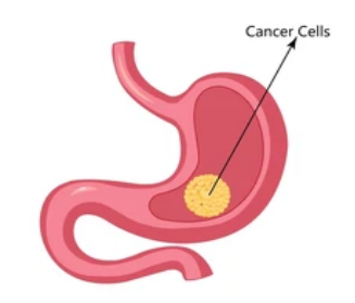 Stomach Cancer