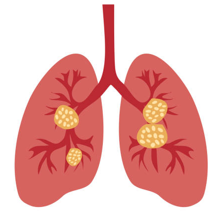 lung